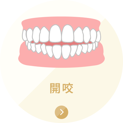 開咬