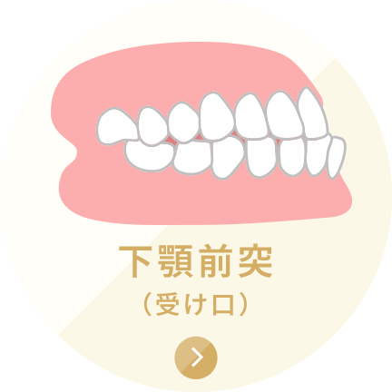 下顎前突（受け口）